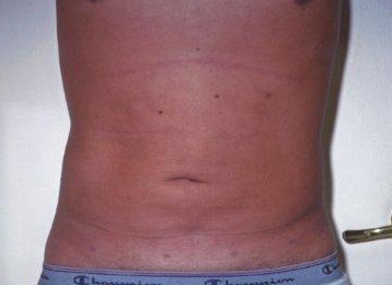 Liposuction Abdomen - After Treatment Photos - male, front view, patient 5