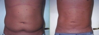 Liposuction Abdomen - Before and After Treatment Photos - male, front view, patient 5