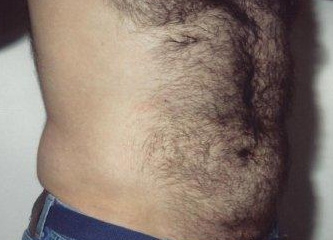 Liposuction Abdomen - After Treatment Photos - male, oblique view, patient 6