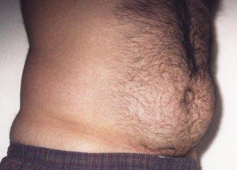 Liposuction Abdomen - Before Treatment Photos - male, oblique view, patient 6