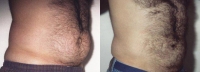 Liposuction Abdomen - Before and After Treatment Photos - male, oblique view, patient 6