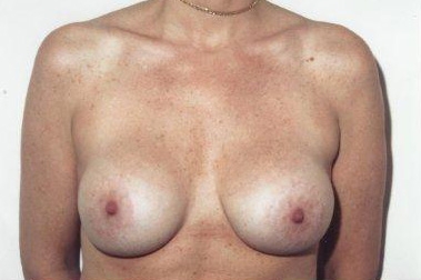 Breast Lift: After Treatment Photos - female, front view, patient 1
