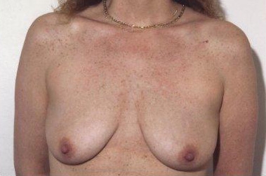 Breast Lift: Before Treatment Photos - female, front view, patient 1