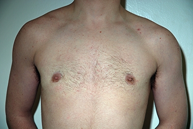 Female to Male Top Surgery. Before and After Treatment Photos - male, left side oblique view, patient 3