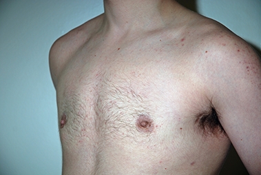 Female to Male Top Surgery. Before and After Treatment Photos - male, left side oblique view, patient 3