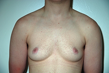 Female to Male Top Surgery. Before and After Treatment Photos - male, left side oblique view, patient 3