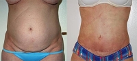Mini Tummy Tuck - Before and After Treatment Photos - female, front view, patient 1