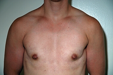 Female to Male Top Surgery. After Treatment Photos - male, front view, patient 1