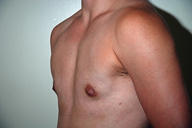Female to Male Top Surgery. After Treatment Photos - male, left side oblique view, patient 1