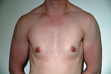 Female to Male Top Surgery. Before Treatment Photos - male, front view, patient 1