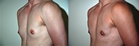 Female to Male Top Surgery. Before and After Treatment Photos - male, left side oblique view, patient 1