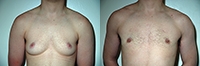 Female to Male Top Surgery. Before and After Treatment Photos - male, left side oblique view, patient 3