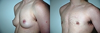 Female to Male Top Surgery. Before and After Treatment Photos - male, left side oblique view, patient 3