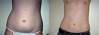 Liposuction Abdomen - Before and After Treatment Photos - male, front view, patient 7
