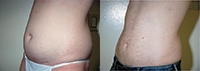 Liposuction Abdomen - Before and After Treatment Photos - male, oblique view, patient 8