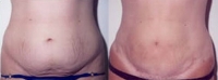Tummy Tuck - Before and After Treatment Photos - female, front view, patient 1