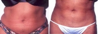 Liposuction Abdomen - Before and After Treatment Photos - female, front view, patient 1