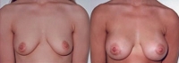 Breast Augmentation: Before and After Treatment Photos - female, front view, patient 1