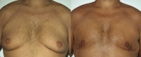 Gynecomastia. Before and After Treatment Photos - male, front view, patient 1