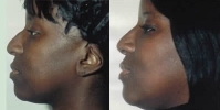 Rhinoplasty. Before and After Treatment Photos - female, left side view, patient 15