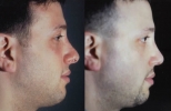 Rhinoplasty. Before and After Treatment Photos - male, right side view, patient 19