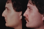 Rhinoplasty. Before and After Treatment Photos - male, left side view, patient 20
