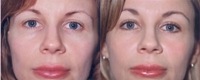 Mid Facelift - Before and After Treatment Photos - female, front view, patient 2