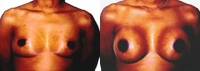Breast Augmentation: Before and After Treatment Photos - female, front view, patient 2