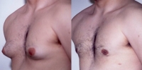 Gynecomastia. Before and After Treatment Photos - male, oblique view, patient 2