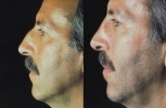 Rhinoplasty. Before and After Treatment Photos - male, left side view, patient 23