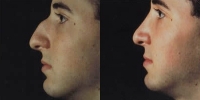 Rhinoplasty. Before and After Treatment Photos - male, left side view, patient 24