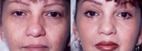 Mid Facelift - Before and After Treatment Photos - female, front view, patient 3