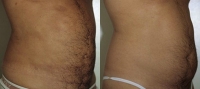 Torsoplasty. Before and After Treatment Photos - male, right side view, patient 3