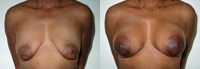 Breast Augmentation: Before and After Treatment Photos - female, front view, patient 3