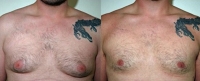 Gynecomastia. Before and After Treatment Photos - male, front view, patient 3