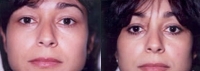 Mid Facelift - Before and After Treatment Photos - female, front view, patient 4