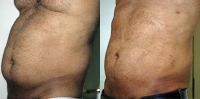 Torsoplasty. Before and After Treatment Photos - male, left side oblique view, patient 4