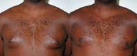 Gynecomastia. Before and After Treatment Photos - male, front view, patient 4