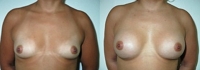 Breast Augmentation: Before and After Treatment Photos - female, front view, patient 5