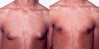 Gynecomastia. Before and After Treatment Photos - male, front view, patient 5