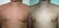 Gynecomastia. Before and After Treatment Photos - male, front view, patient 6