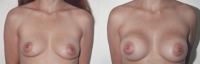 Breast Augmentation: Before and After Treatment Photos - female, front view, patient 7