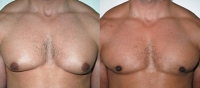 Gynecomastia. Before and After Treatment Photos - male, front view, patient 8