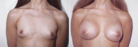 Breast Augmentation: Before and After Treatment Photos - female, front view, patient 8