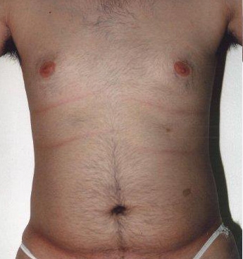 Torsoplasty. Before Treatment Photos - male, front view, patient 5