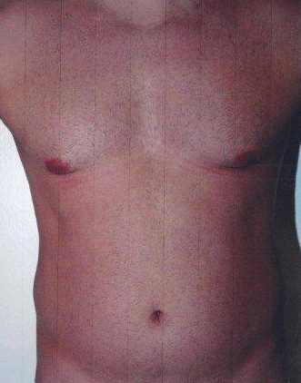 Torsoplasty. Before Treatment Photos - male, front view, patient 6