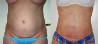 Tummy Tuck - Before and After Treatment Photos - female, front view, patient 4