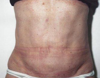 Tummy Tuck - After Treatment Photos - female, front view, patient 2