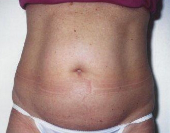 Tummy Tuck - Before Treatment Photos - female, front view, patient 2