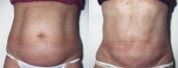 Tummy Tuck - Before and After Treatment Photos - female, front view, patient 2